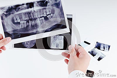 Panoramic dental x-ray image of teeth. Stock Photo