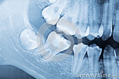 Film x-ray of teeth. Stock Photo