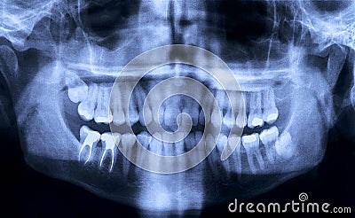 Panoramic dental X-Ray Stock Photo