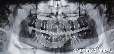 Panoramic dental X-ray - 31 teeth Stock Photo