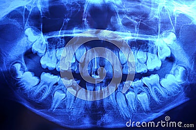 12-year old - panoramic dental x-ray Stock Photo