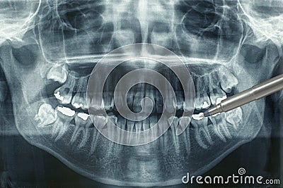 Panoramic dental xray Stock Photo