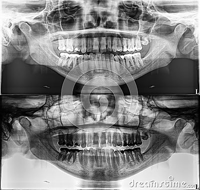 Panoramic dental Xray, fixed teeth, dental amalgam seal, wisdom tooth on side, horizontally impacte Editorial Stock Photo