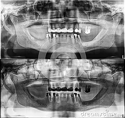 Panoramic dental Xray, fixed teeth, dental amalgam seal, dental crown and bridge, filled root canal Editorial Stock Photo