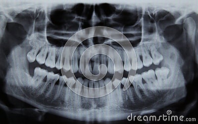 Panoramic dental Xray Stock Photo