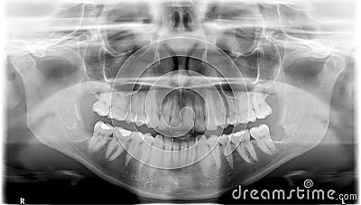 Panoramic dental Xray Stock Photo