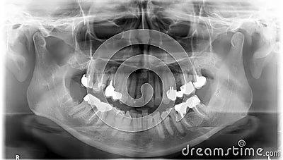 Panoramic dental Xray Stock Photo