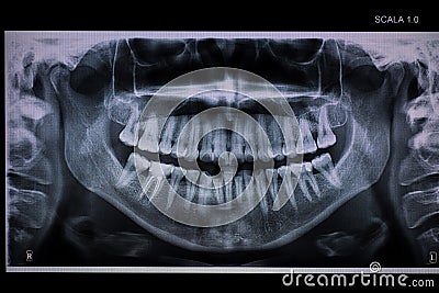 Panoramic dental XRay with a root canal Stock Photo