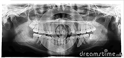 Panoramic image of the jaw, the location of the atypical / pathological wisdom tooth third molar. Medical research, Stock Photo