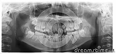 Panoramic X-ray Of Mixed Dentition Teeth Stock Images - Image: 33407724