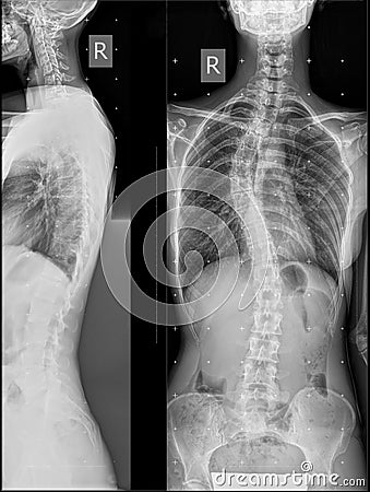 Single arc right sided deformity of the thoracic spine Stock Photo