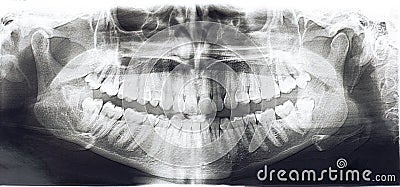 Panoramic x-rays teeth Stock Photo