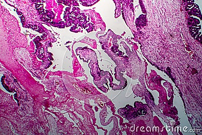 Papillary serous ovarian adenocarcinoma, light micrograph Stock Photo