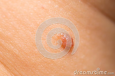 Macro of Papillomas or mole on female neck close up background Stock Photo