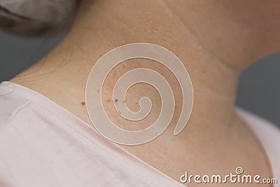 Papillomas on the skin of the neck Stock Photo