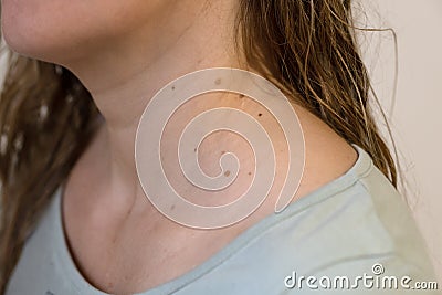 Papillomas on the woman neck close up Stock Photo