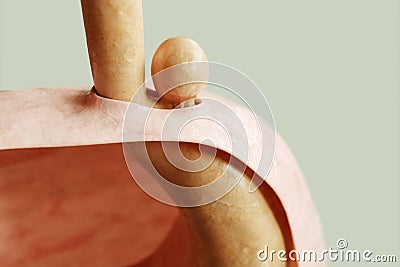 Paraesophageal Hiatus Hernia Type 2 - 3D rendering Stock Photo