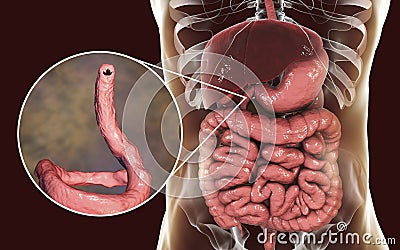 Parasitic hookworm Ancylosoma duodenale in human duodenum Cartoon Illustration