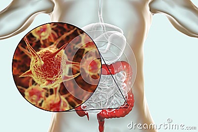 Parasitic infection of intestine Cartoon Illustration