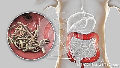 Parasitic worms in human large intestine Cartoon Illustration