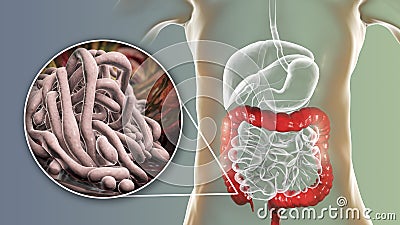 Parasitic worms in human large intestine Cartoon Illustration