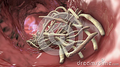 Parasitic worms in the lumen of intestine Cartoon Illustration