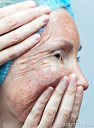 Parchment skin before rejection.Chemical peeling. Stock Photo