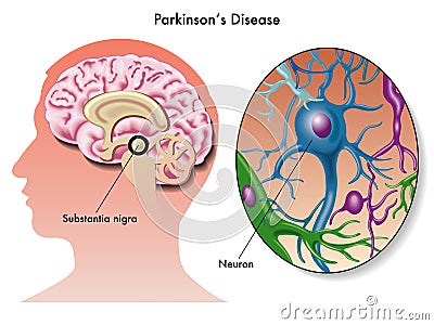 Parkinson's disease Vector Illustration