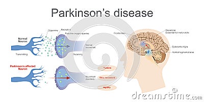 Parkinson`s Affected neuron. Health care education infographic. Stock Photo