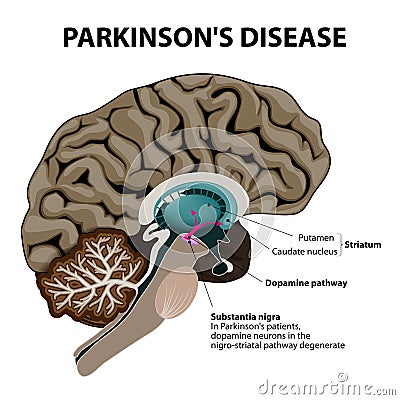 Parkinsons Disease Vector Illustration