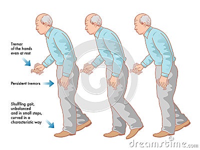 Parkinsons disease Cartoon Illustration