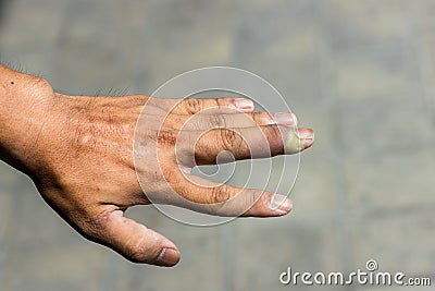 Paronychia, swollen finger with fingernail bed inflammation due to bacterial infection on a toddlers hand. Stock Photo