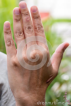 Paronychia, swollen finger inflammation due to bacterial infection on a man hand. Wound infection on the skin. A wound on the huma Stock Photo