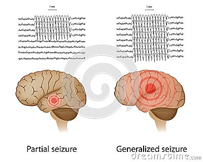epilepsy eeg vs normal eeg epilepsy eeg vs normal eeg