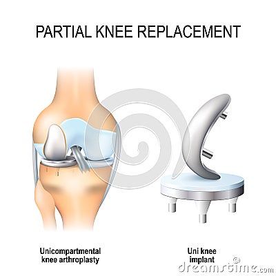 Partial knee replacement. Vector Illustration