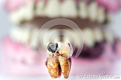 Partial wooden dentures and real tooth with caries and cavities. Dental Health care Stock Photo