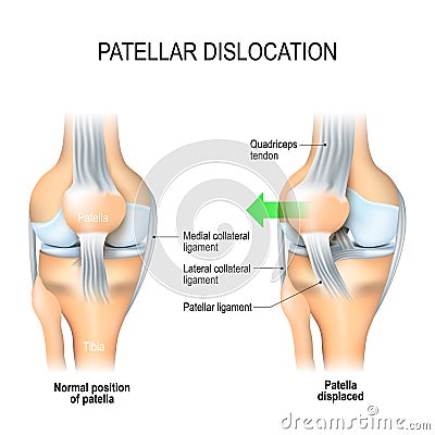 Patellar dislocation Vector Illustration
