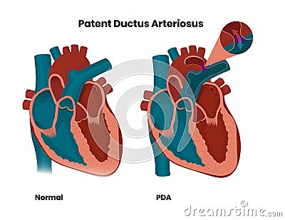 Patent ductus arteriosus with normal heart anatomy. Illustration of the congenital heart anomaly Vector Illustration