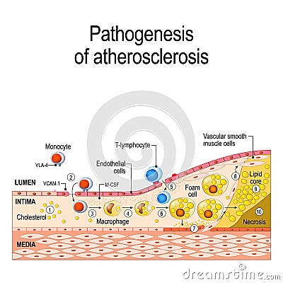 Pathogenesis of atherosclerosis Vector Illustration