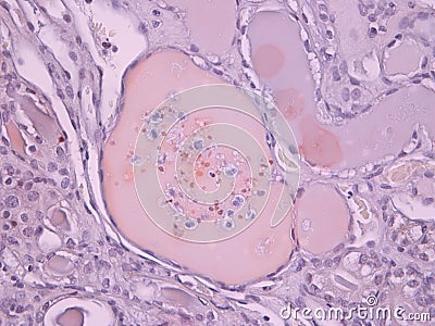 Pathology of Kidney Glomerulus Stock Photo