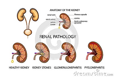 Pathology of the kidneys. Vector Illustration