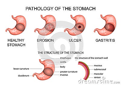 Pathology of the stomach Vector Illustration