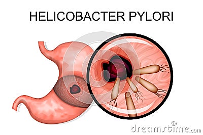 Pathology of the stomach. Helicobacter pylori Vector Illustration