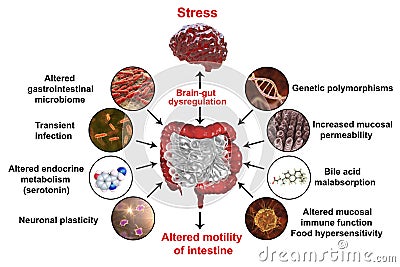 Pathophysiology of irritable bowel syndrome IBS Cartoon Illustration