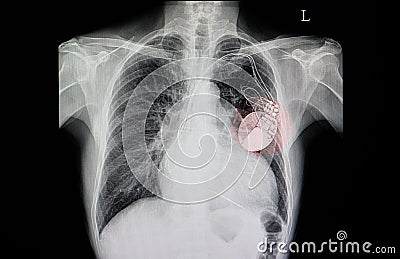 patient with cardiac pacemaker Stock Photo