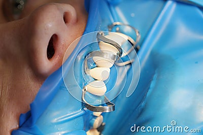 Patient at dentist office to install dentures or veneers closeup Stock Photo