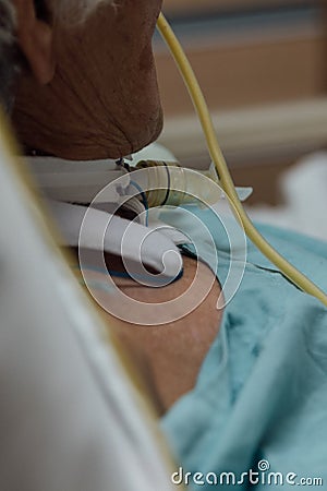Patient do tracheostomy and ventilator in hospital Stock Photo