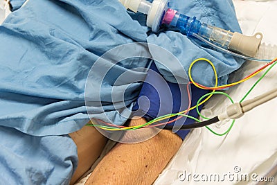 Patient do tracheostomy and ventilator in hospital Stock Photo