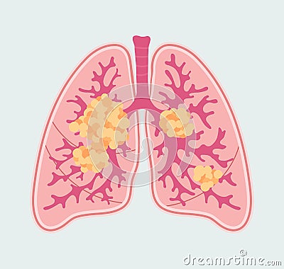 Patient-friendly scheme of Lung Cancer. Anatomical Diagram of tumor and metastasis in respiratory organs Vector Illustration
