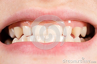 Patient with gingival smile, large gums and small teeth, microdentia, close-up Stock Photo